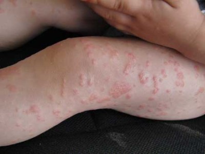 Аллергия на фолиевую кислоту симптомы