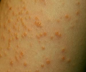 Аллергия на солярий симптомы