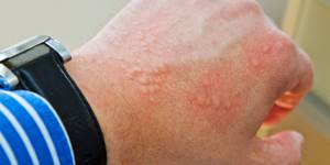 Аллергия на арбуз симптомы