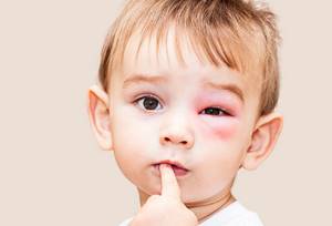 Аллергия на малину симптомы