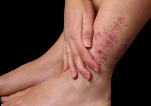 Аллергия на ногах сыпь
