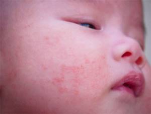 Пищевая аллергия у ребенка лечение