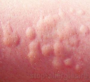 Аллергия как укусы насекомых