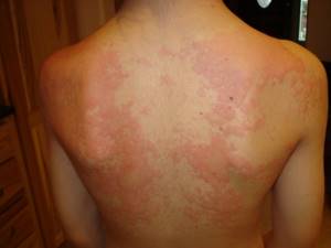 Аллергия в июле