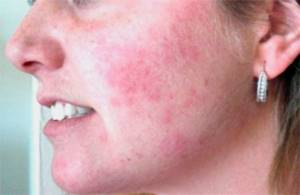 Аллергия на ромашку симптомы