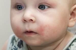 Аллергия у месячного ребенка при грудном вскармливании