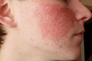 Пищевая аллергия на лице