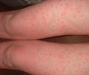К чему может привести аллергия