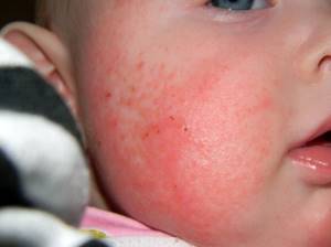 Аллергия на витамин д у ребенка