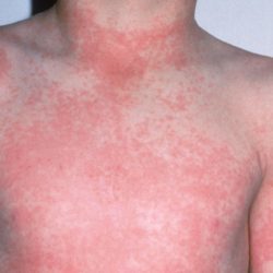 Как лечить аллергическую сыпь у взрослого