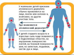 Лечение атопического дерматита у детей народными средствами