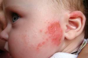 Анализы при аллергии у взрослых