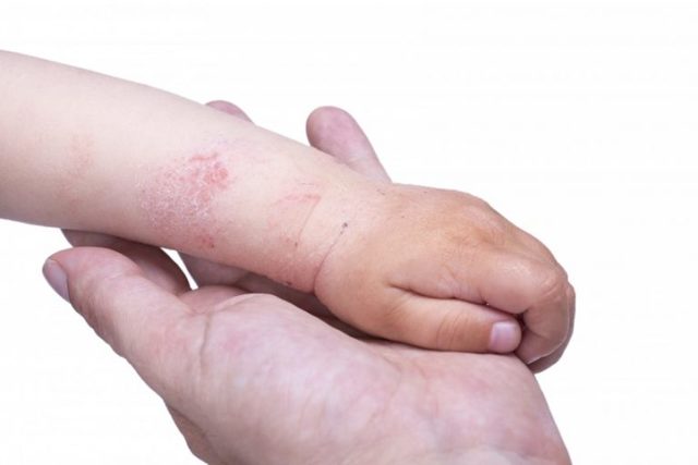 Как выглядит аллергия на руках