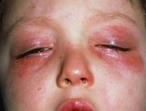 Первая помощь при аллергии на коже
