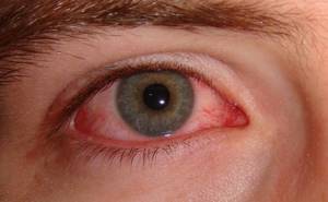 Аллергия на линзы симптомы
