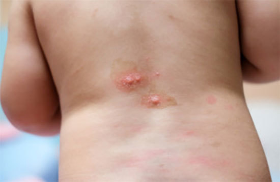 Аллергия на укусы насекомых у детей