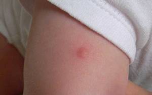 Укусы комаров у детей лечение