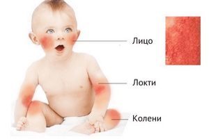 Аллергия на кефир у ребенка