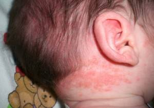 Аллергия на ванилин у ребенка