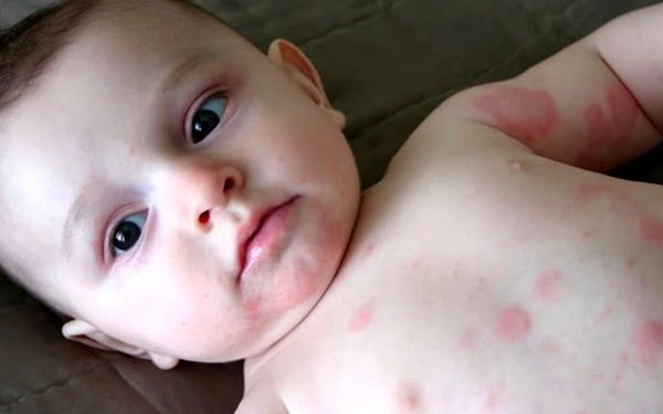 Аллергия у ребенка на бепантен