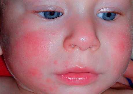 Аллергия на плесень симптомы