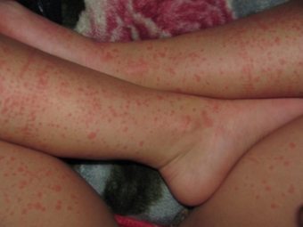Аллергия на порошок как проявляется