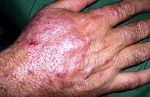 Лечение дерматита на руках у взрослых