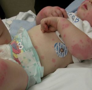 Бывает ли температура при аллергии у ребенка
