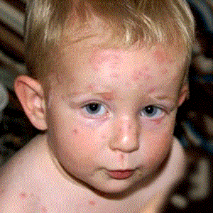 Аллергия на животных у новорожденных