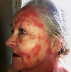 Аллергическая сыпь на лице у взрослого лечение