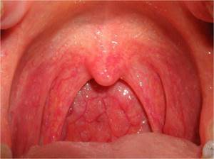 Может ли болеть горло из за аллергии