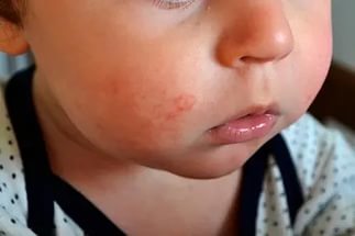 Психосоматика аллергия у детей
