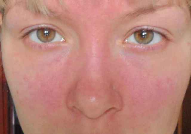 Пищевая аллергия на лице