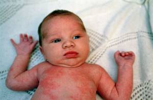 Аллергия у новорожденных как лечить