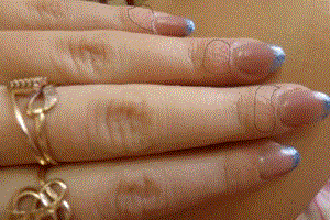 Аллергия на нарощенные ногти