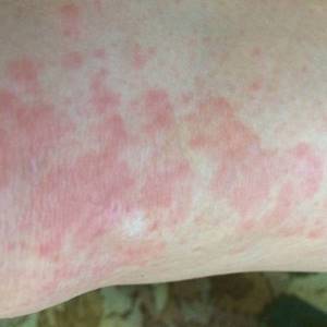 Аллергия на цементную пыль симптомы