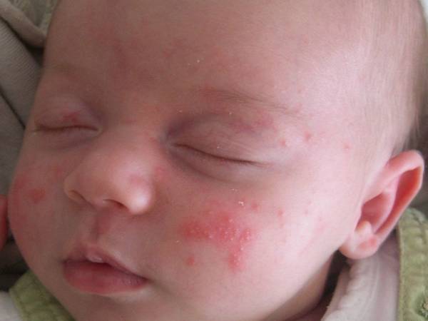 Мазь от аллергического дерматита для детей