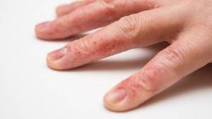 Аллергия на латекс у мужчин симптомы