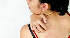 Средства против аллергии на коже