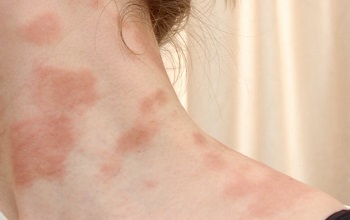 Как лечить аллергическую сыпь у взрослого