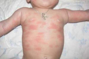 Крапивница у ребенка как лечить доктор комаровский