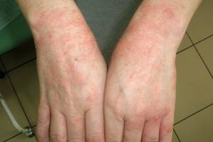 Аллергический дерматит заразен или нет